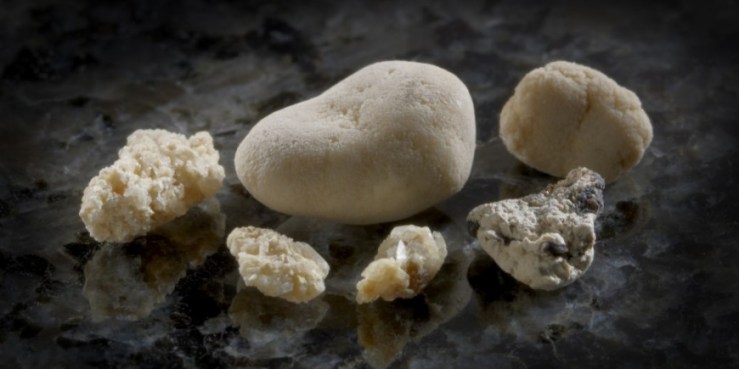 nierensteine-870x435