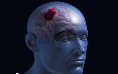 63c79-ictus-hemorragico