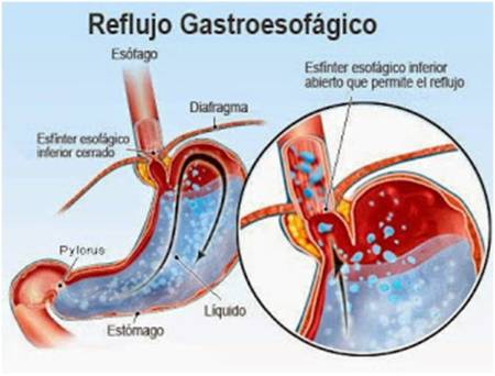 Esófago de Barrett_1