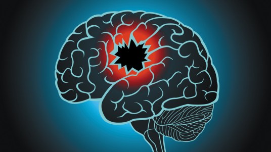 Resultado de imagen de lesion cerebral